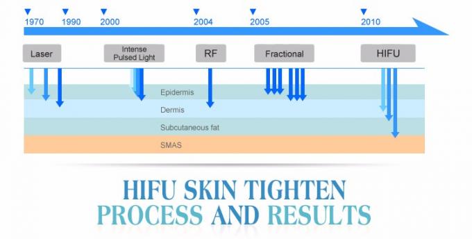 2016 του προσώπου προσοχής SMAS ρυτίδων αφαίρεσης μηχανή hifu επεξεργασίας ιατρική